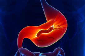 Participez aux discussions les plus actives. Helicobacter Pylori Symptomes Et Traitements En Cas D Infection