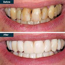 Deep Teeth Cleaning Yonkers | Dental Cleaning Cost In Yonkers, Ny