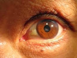 What Is Corneal Scarring?