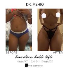 I inquired about a procedure with dr mehio. Mia Aesthetics Snatched Beautiful Bbl Results By Dr Facebook