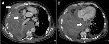 We did not find results for: Clinical Staging Of Malignant Pleural Mesothelioma Current Perspectiv Lctt