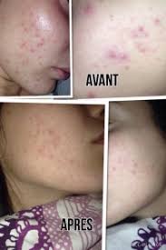 Les peelings faits maison c'est possible ! Masque Anti Points Noirs Ou Pores Dilates Peau Neuve