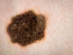 But hearing the words can still be scary. Home Remedy For Skin Cancer May Cause Damage Mask New Growth