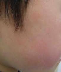こどもの感染症 はやし小児科医院