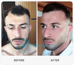 Graft survival in a transplant: Best Hair Transplant Turkey Istanbul Best Hair Transplant Hair Implantation Turkey