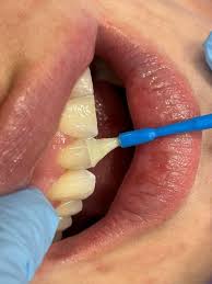 Image result for Topical Fluoride