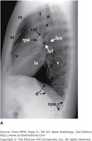 Gillian lieberman forthe harvard 62. Chapter 4 Radiology Of The Chest Radiology Key