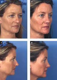 Photos avant et après du résultat de rhinoplastie, une intervention de chirurgie esthétique qui corrige la forme du nez pour obtenir un visage plus équilibré. Rhinoplastie Tunisie Prix Chirurgie Esthetique Nez