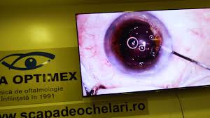 Interventia dureaza cateva minute in functie de stadiul cataractei, operatia poate dura intre 7 si 15 minute. Operatia De Cataracta La Dr Andrei Filip Pentru Ca Exista Ingeri Intruchipati In Medici De Exceptie Urbandiva Ro