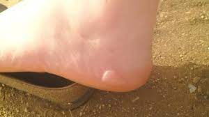 Comment faire partir une ampoule. Petits Remedes Efficaces Pour Soigner Naturellement Les Ampoules