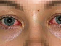 Stevens Johnson Syndrome Toxic Epidermal Necrolysis Dermnet Nz
