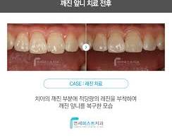 이빨 깨짐 치료 전후 비교