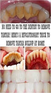 Tartar Is Mineralized Dental Plaque Usually Brown Or Yellow In Color The Appearance Of Tartar Can Cause Many Oral D Teeth Health Dentist Natural Home Remedies