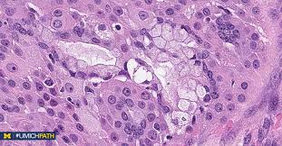 Deep dermal infiltration with perineural invasion is common. Michigan Pathology On Twitter A Mucoepidermoid Carcinoma Intermediate Grade T 11 19 Q21 P13 Crtc1 Maml2 Fusion Aka Mect1 Maml2 Most Common Malignant Sg Tumor Triphasic W Epidermoid Intermediate Mucous Cells 3 Complex Grading Systems