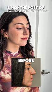 Stunning Results: 8 Months After Minimally Invasive Rhinoplasty