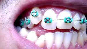 Aparelho Ortodontico Dentes Tortos Youtube