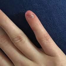 Diese methode ist eine echte alternative zu acrylnägeln. Nagel Total Kaputt Trotzdem Gelnagel Gesundheit Und Medizin Beauty Acrylnagel
