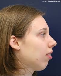 Convex Profile Receding Forehead And Chin It Calls For An Arrangement Of Curls Or Bangs Over The Forehead Keep T Face Profile Face Shapes How To Style Bangs