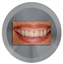 How can i put a smile on my face in photoshop? Gummy Smile Correction What Are Your Options Northstar Dental