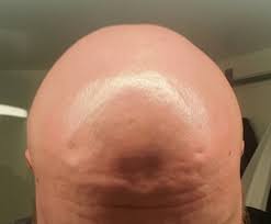 I mentioned last week that i just finished a series of laser hair removal. Bigbaldqueer Tumblr Blog With Posts Tumbral Com