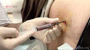 Maybe you would like to learn more about one of these? Bone Marrow Aspiration And Biopsy From The Iliac Crest Oncolex Youtube