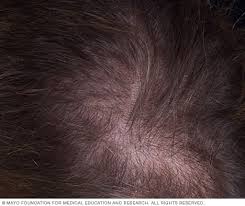 Hair loss can be an upsetting condition to deal with. Hair Loss Symptoms And Causes Mayo Clinic