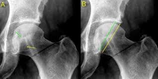 Image result for Femoral Retroversion
