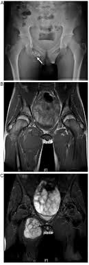 It affects mostly teens and young adults. Analysis Of Imaging Characteristics Of Primary Malignant Bone Tumors In Children