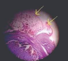 Images selected from internet and/or free sources. Jcdr Appendices Epiploicae Lymphoid Infiltration Mesentery Torsion