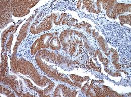Melanin helps to protect the body from ultraviolet light (uv radiation) from the sun. Colon Cancer Awareness Month 2020