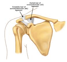 Learn more about acl tear treatment. Patient Education Acromioclavicular Joint Injury Shoulder Separation Beyond The Basics Uptodate
