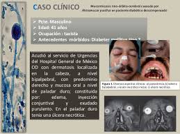 La mucormicosis es una infección micótica de los senos paranasales, el cerebro o los pulmones que suele presentarse en personas con un sistema inmunitario debilitado o con órganos trasplantados. Mucormicosis