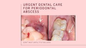 Image result for Periodontal Abscess