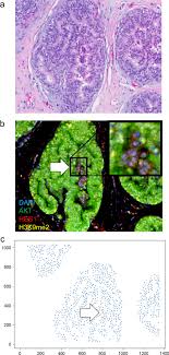 Cervical carcinoma in situ means that the cells are cancerous, and that they have not moved out of the location from where they originated. so literally, carcinoma in situ is a cancer that's still in its original place — and is at its most curable form. Akt1 Low Quiescent Cancer Cells In Ductal Carcinoma In Situ Of The Breast Npj Breast Cancer