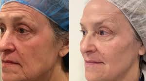 Thread lift before and after eyes. Thread Lift What To Expect Cost Recovery And More