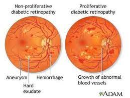 Image Result For Proliferative Vs Nonproliferative Diabetic Retinopathy Diabetic Retinopathy Diabetes Eye Facts