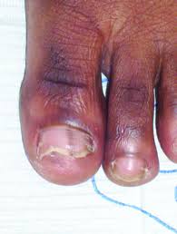 In more advanced melanoma, the texture of the mole may change. How To Detect Nail Unit Tumors Podiatry Today