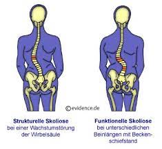 Ruckenschmerzen Ischias Hexenschuss Www Patientenleitlinien De Ruckenschmerz Lumbago