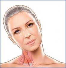 Check spelling or type a new query. Distonia Cervical Torticolis Espasmodica Cervical Que Es