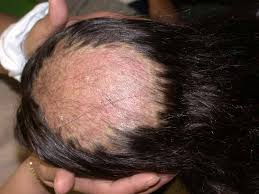 Trusted advice on use, warnings, side effects, how long it takes to work the most common side effects are reduced appetite, indigestion, feeling sick, stomach ache, diarrhoea, rash and aching muscles or joints. Tinea Capitis Ringworm Tinea Tonsurans Dermatology Advisor