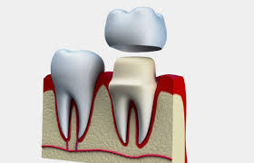 If you've recently been told that you need a root canal, you may be wondering if the procedure is necessary. Why We Recommend A Dental Crown After Root Canal Treatment