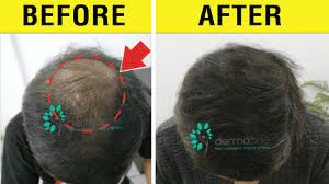 Collagenesis peaks at 14 days after treatment. Dermaroller For Hair Loss Is It Effective How To Use A Derma Roller On Your Scalp For Hair Growth Youtube