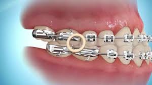 The condition behind your knee pain should help guide you in selecting the best brace. Elastics Orthodontic Specialists Llc St George Ut