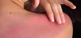 Check spelling or type a new query. How To Treat First Degree Burn Wounds Alhydran