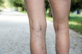 Endovenous radiorequency ablation (vnus procedure) enovenous laser ablation Get Your Varicose Vein Procedure Covered By Insurance Denver Vein Center