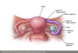 Ovarian cancer is one of those nightmare cancers: Ovarian Cancer Symptoms Diagnosis Treatment Md Anderson Cancer Center