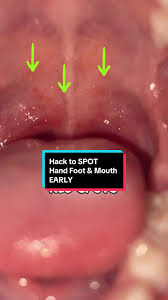 Image result for Hand foot and mouth disease HFMD roof of mouth