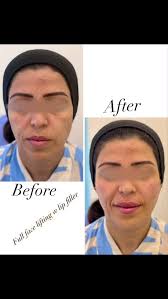 رفعنا الخدود 💉 ورجعنالها شبابها الطبيعي ✨ قبل وبعد… فرق بيحكي عن نفسه 💎