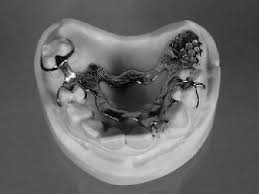 What are the options for partial dentures? Classical Upper Partial Denture Framework With Free End Saddle Clasp Download Scientific Diagram