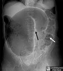 Sigmoid Volvulus Dilated Loop Of Sigmoid Colon Has A Coffee Bean Shape And The Wall Between The Two Volvulated L Radiology Imaging Radiology Radiology Humor